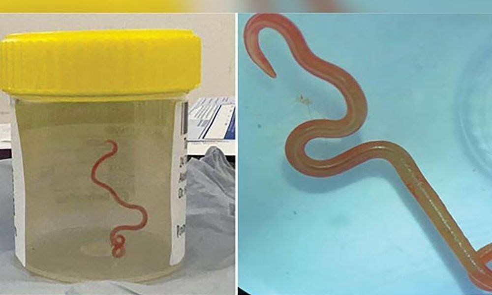 First Ever: Live Parasitic Worm in Australian Woman's Brain